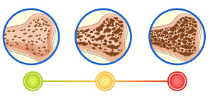 Учёные Сибири и Канады впервые описали остеопороз с точки зрения минералогии